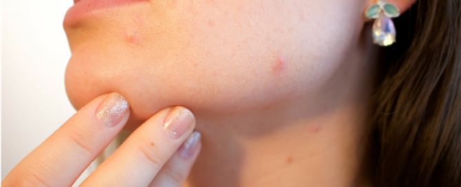 Acne & Hypothyroidism